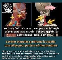 肩甲挙筋の筋緊張とその関連筋が姿勢に与える影響について学び、マッサージとストレッチによる痛みの軽減と姿勢改善を学びます